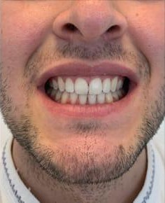 Önce - Gülüş tasarımı