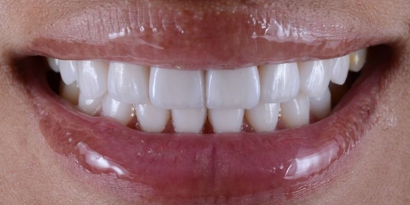 Önce - Gülüş tasarımı