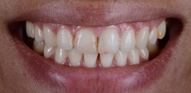 Sonra - Gülüş tasarımı